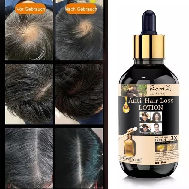 Rootandremedy Anti-Hair Loss Lotion Serum for hair Growth and stop hair fall-30ML (Pack of 2pcs)