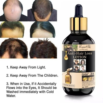 Rootandremedy Anti-Hair Loss Lotion Serum for hair Growth and stop hair fall-30ML (Pack of 2pcs)